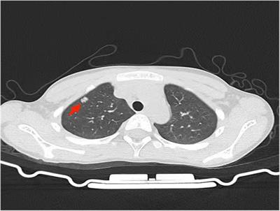 Case Report: Reiterating the importance of tissue biopsy in the diagnosis of tuberculosis: lessons from a case of pediatric pulmonary tuberculosis complicated by Hodgkin's lymphoma